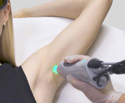 laser hair removal myths