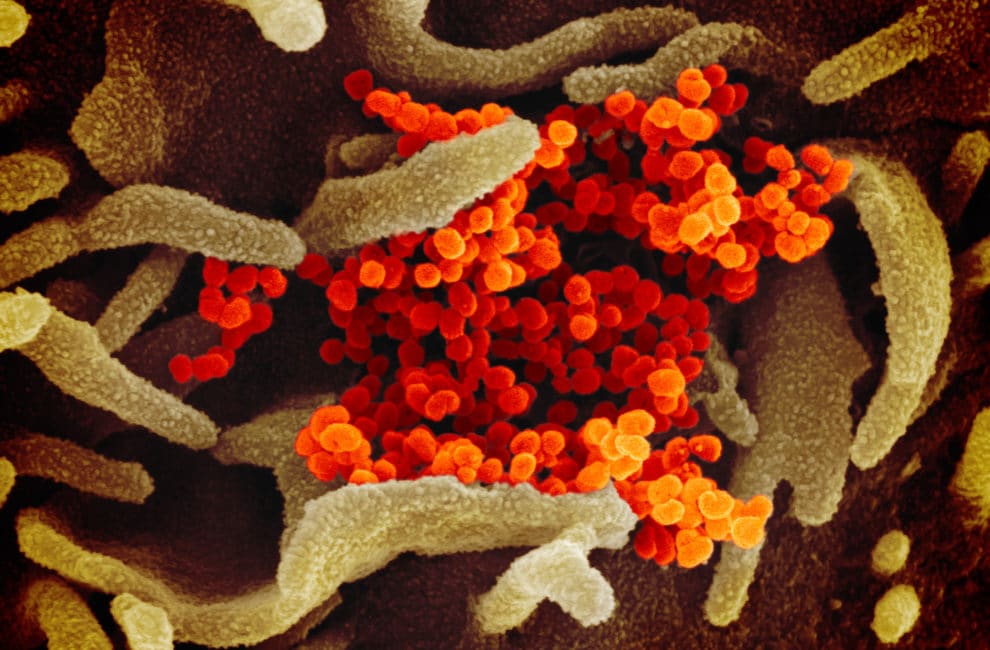 This scanning electron microscope image shows the virus that causes COVID-19 isolated from a patient in the U.S., emerging from the surface of cells (green) cultured in the lab.